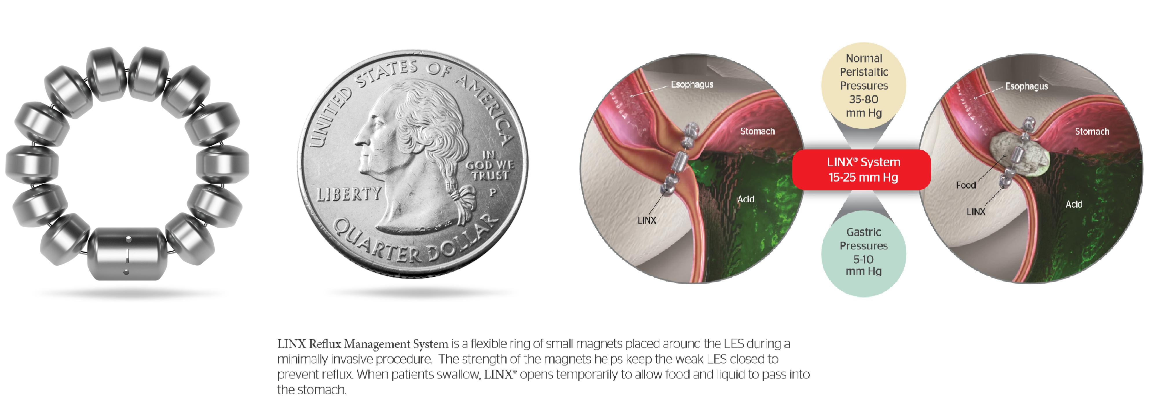 Gastroesophageal reflux disease: MedlinePlus Medical Encyclopedia