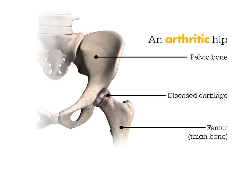 arthritic hip