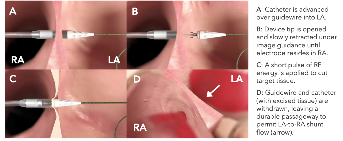 Illustration of heart and ALLAY-HF device procedure